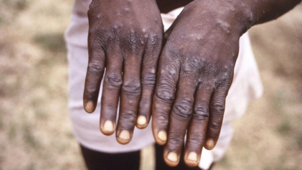 WHO fears increased spread of monkeypox