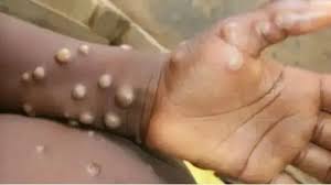 Health Ministry Issues Mpox Alert