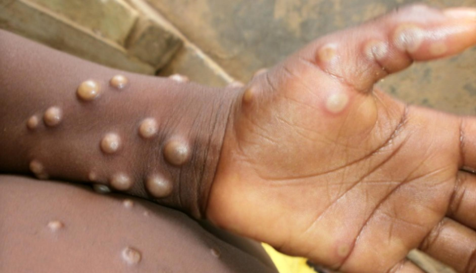 St Lucia Ramps Up Monkeypox Surveillance