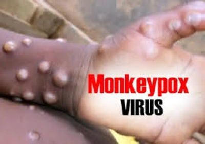 St Catherine woman tests positive for monkeypox locally