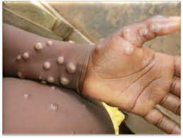 One more case of Monkeypox confirmed in Jamaica